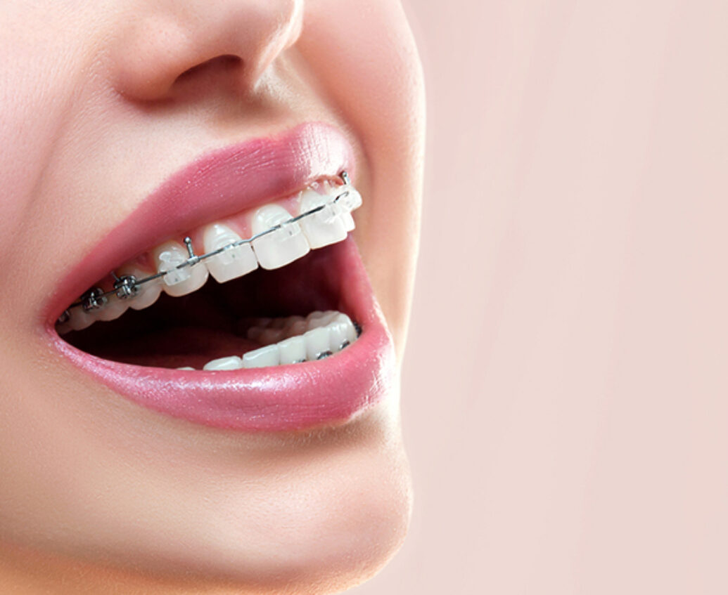 invisalign-thumb2 invisalign thumb