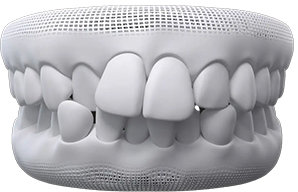 Crowded teeth Crowded teeth