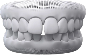 Gaps between teeth Gaps between teeth