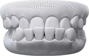 Underbite Underbite